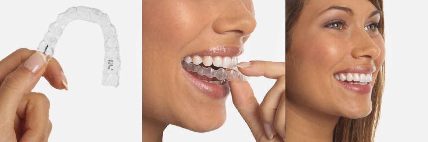 Invisalign Basel