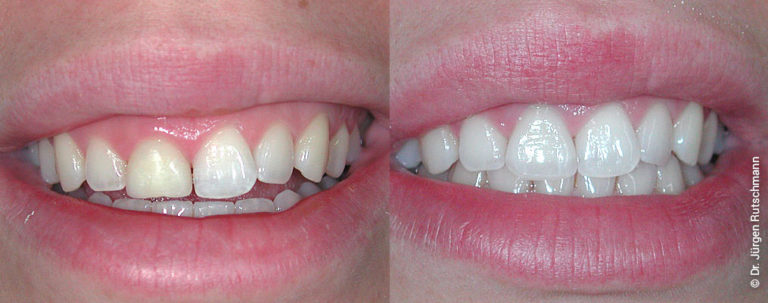 Mit Veneers und Lumineers zu schönen Zähnen – Ihr Zahnarzt in Basel