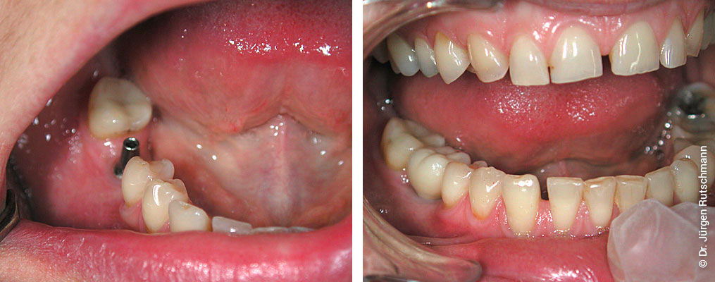 Zahnimplantate Zahnarzt Basel